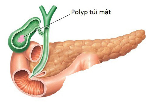 Ảnh 2 của Gallbladder polyp